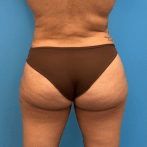 Case--25704 | After Liposuction 2
