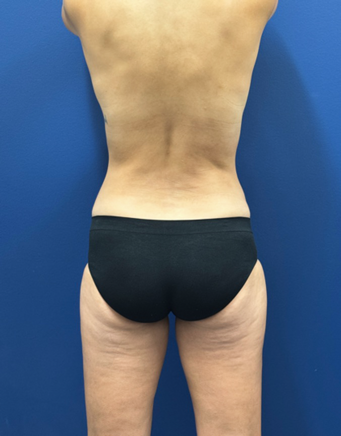 Breast-Augmentation-Tummy-Tuck-Case--29010 | After Breast Augmentation With Lift 5