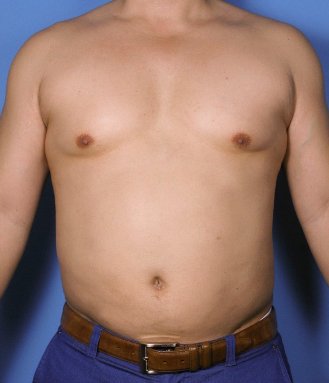 Case--389 | After Liposuction 1