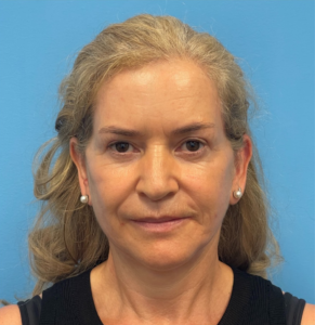 Facelift-Case--292 | After Facelift 1