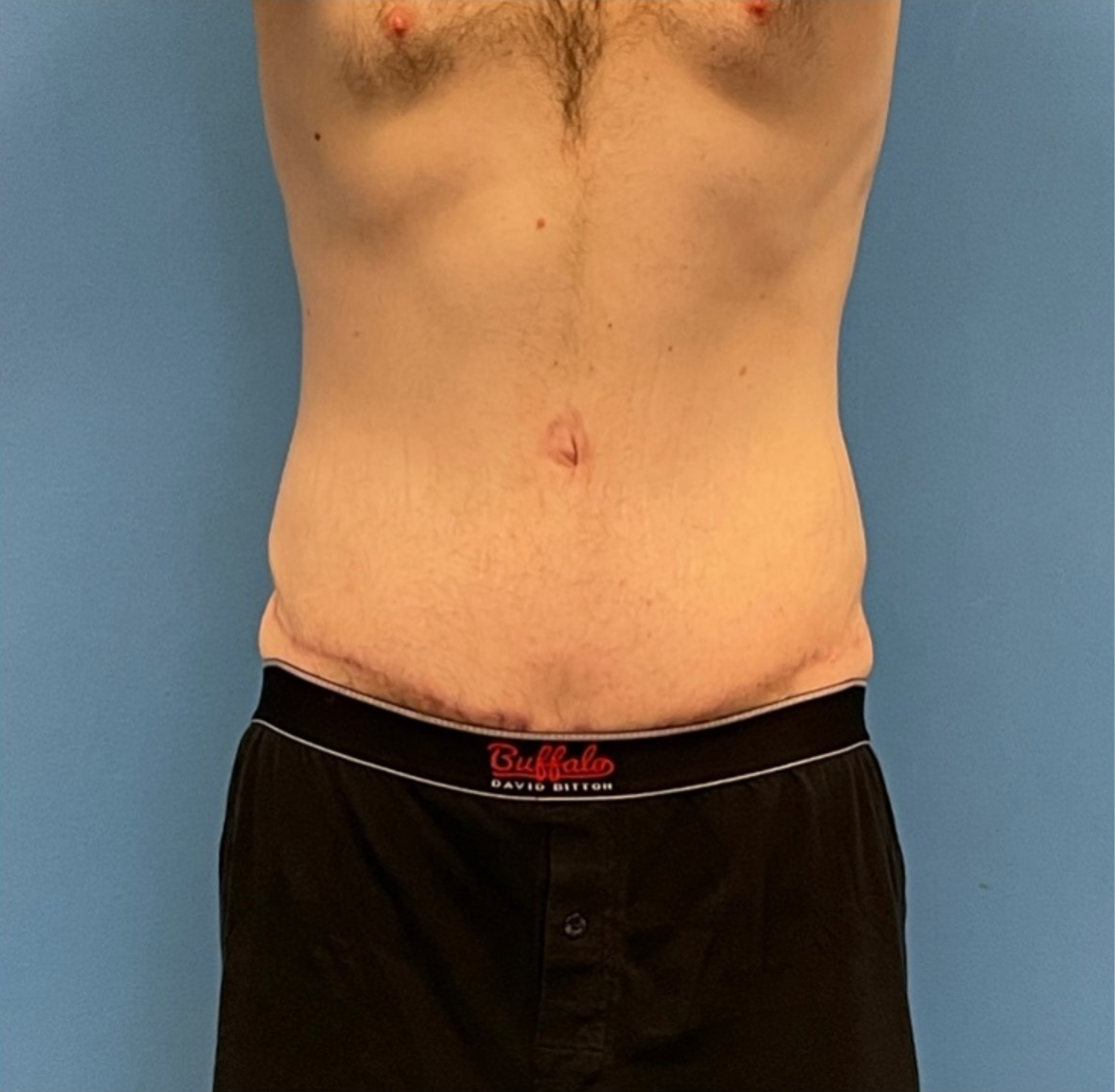 Body-Lift-Case--273 | After Tummy Tuck 1