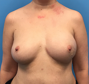 Case--136 | After Breast Reconstruction 1