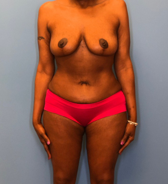 Mommy-Makeover-Case--13869 | After Mommy Makeover 1