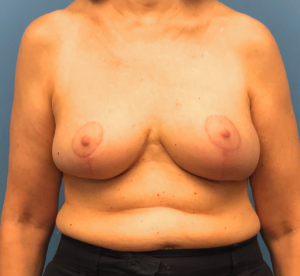 Breast-Reduction-Case--13180 | After Breast Reduction 1