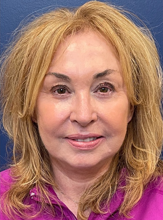 Facelift-Case--22860 | After Facelift 1