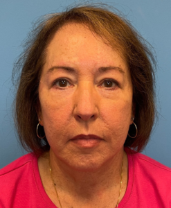 Facelift-Case--21241 | After Facelift 1