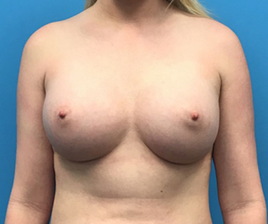 Case--94 | After Breast Augmentation 1