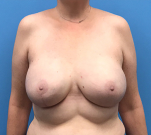 Case--135 | After Breast Reconstruction 1