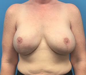 Case--137 | After Breast Reconstruction 1