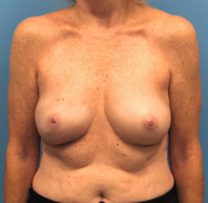 Case--13861 | After Breast Reconstruction 1
