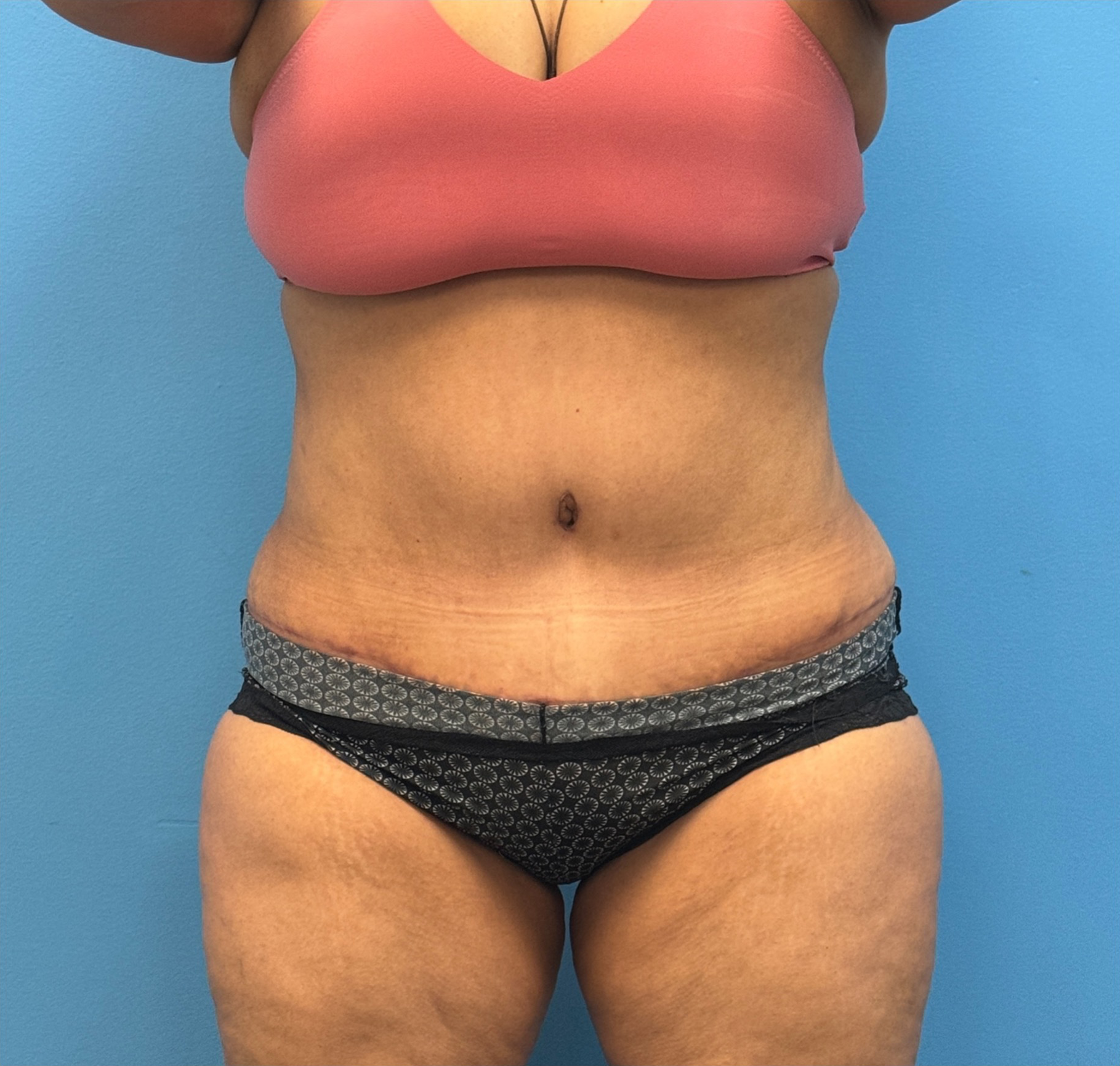 Tummy-Tuck-Case--27602 | After Liposuction 1
