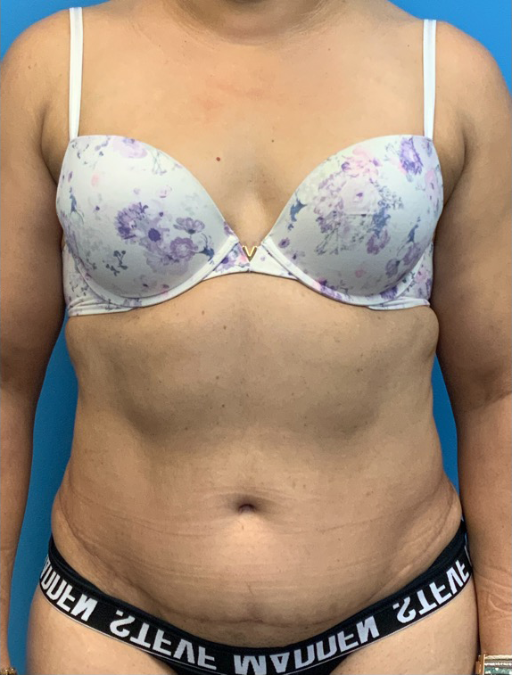 Tummy-Tuck-Case--25988 | After Tummy Tuck 1