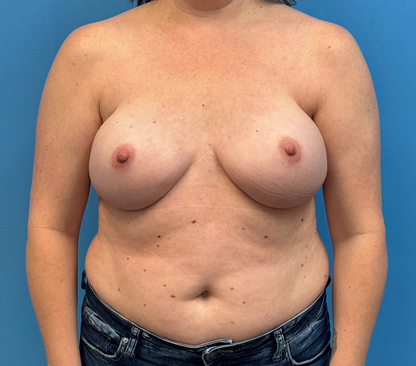 Breast-Reconstruction-Case--27065 | After Breast Reconstruction 1