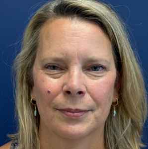 Blepharoplasty-Case--13622 | After Eyelid Surgery 1