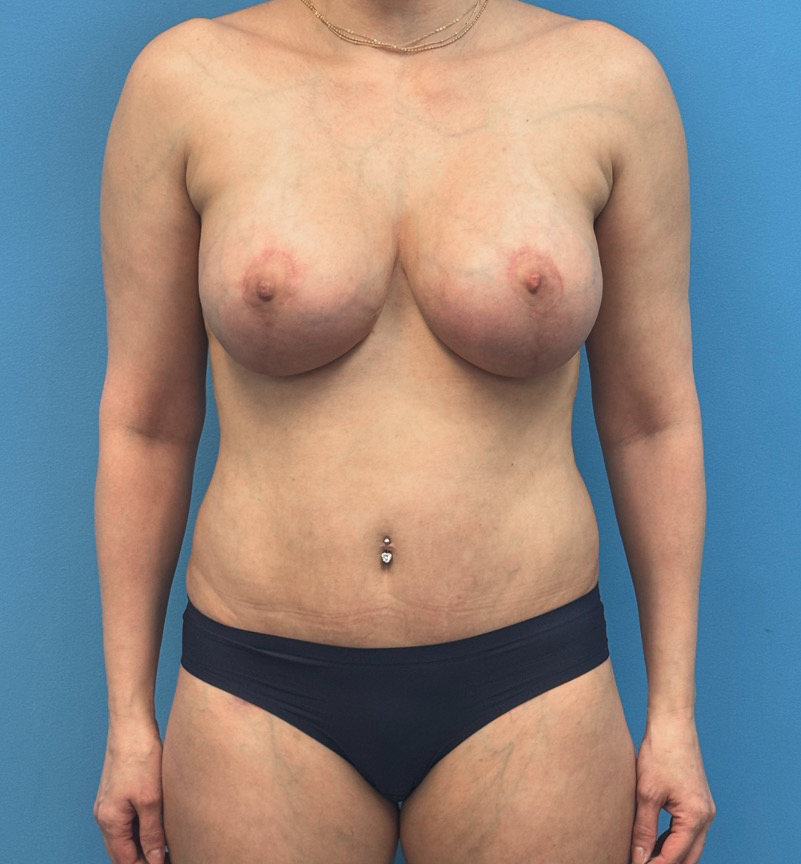 Breast-Augmentation-Tummy-Tuck-Case--28080 | After Breast Augmentation With Lift 1