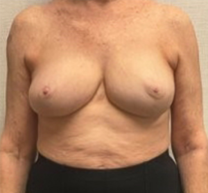 Breast-Reconstruction-Case--24804 | After Breast Reconstruction 1