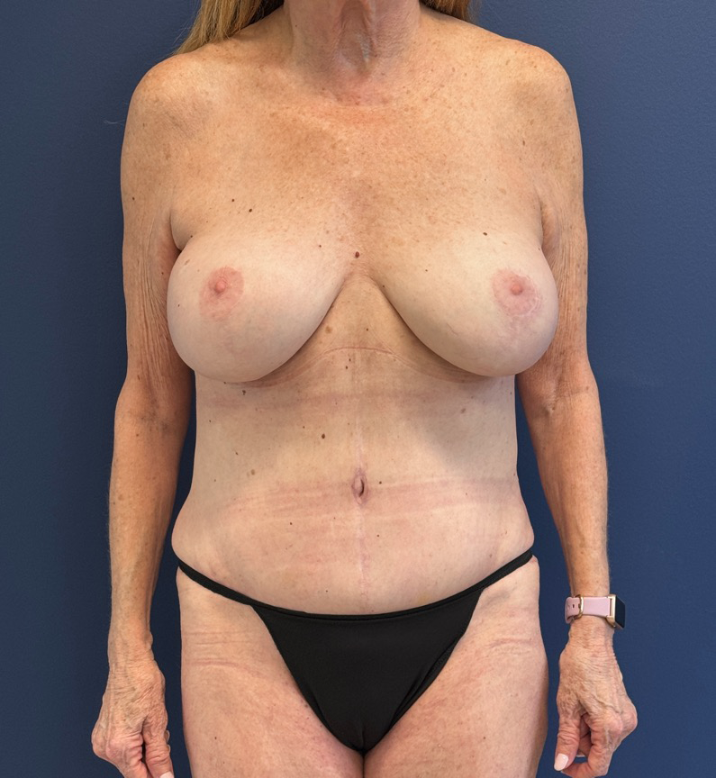 Tummy-Tuck-Liposuction-Case--27935 | After Liposuction 1