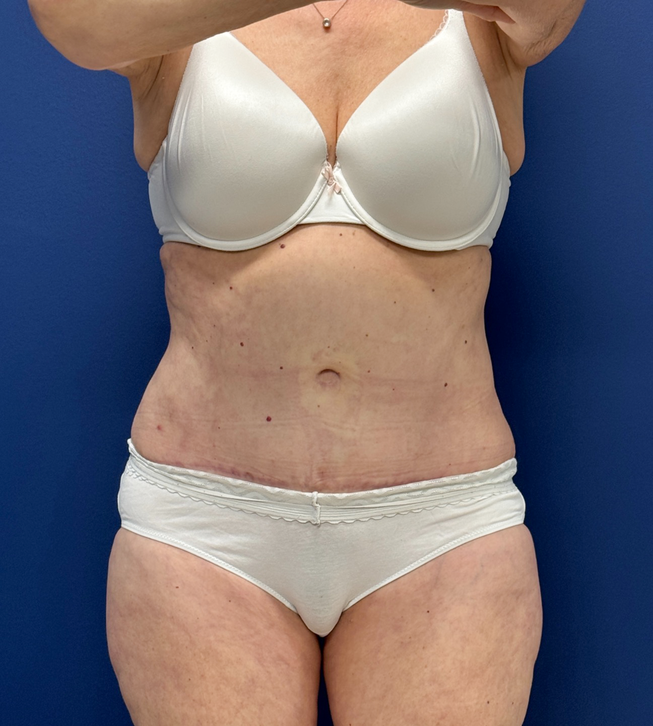 Liposuction-Tummy-Tuck-Case--23690 | After Liposuction 1
