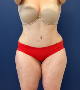 Tummy-Tuck-Case--28426 | After Tummy Tuck 1