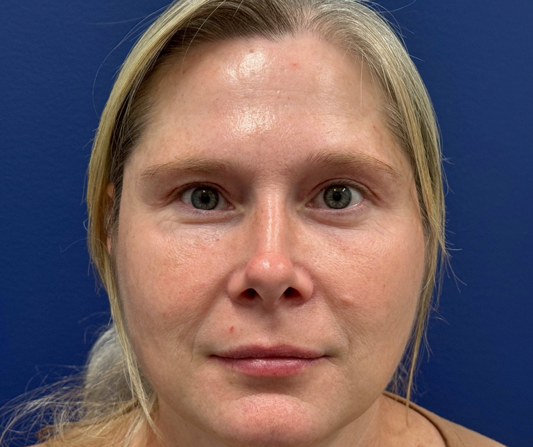 Blepharoplasty-Case--29601 | After Eyelid Surgery 1