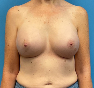 Breast-Augmentation-Case--27374 | After Dr. Frank Albino 1