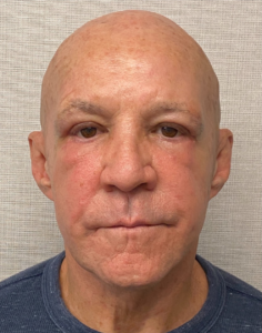 Blepharoplasty-Case--24169 | After Dr. Arjun Kanuri 2