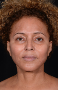 Facelift-Case--360 | After Facelift 1