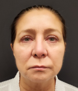 Quad-Blepharoplasty-Case--358 | After Dr. Arjun Kanuri 1