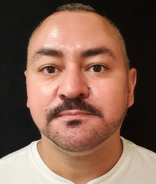 Liposuction-Case--368 | After Liposuction 1