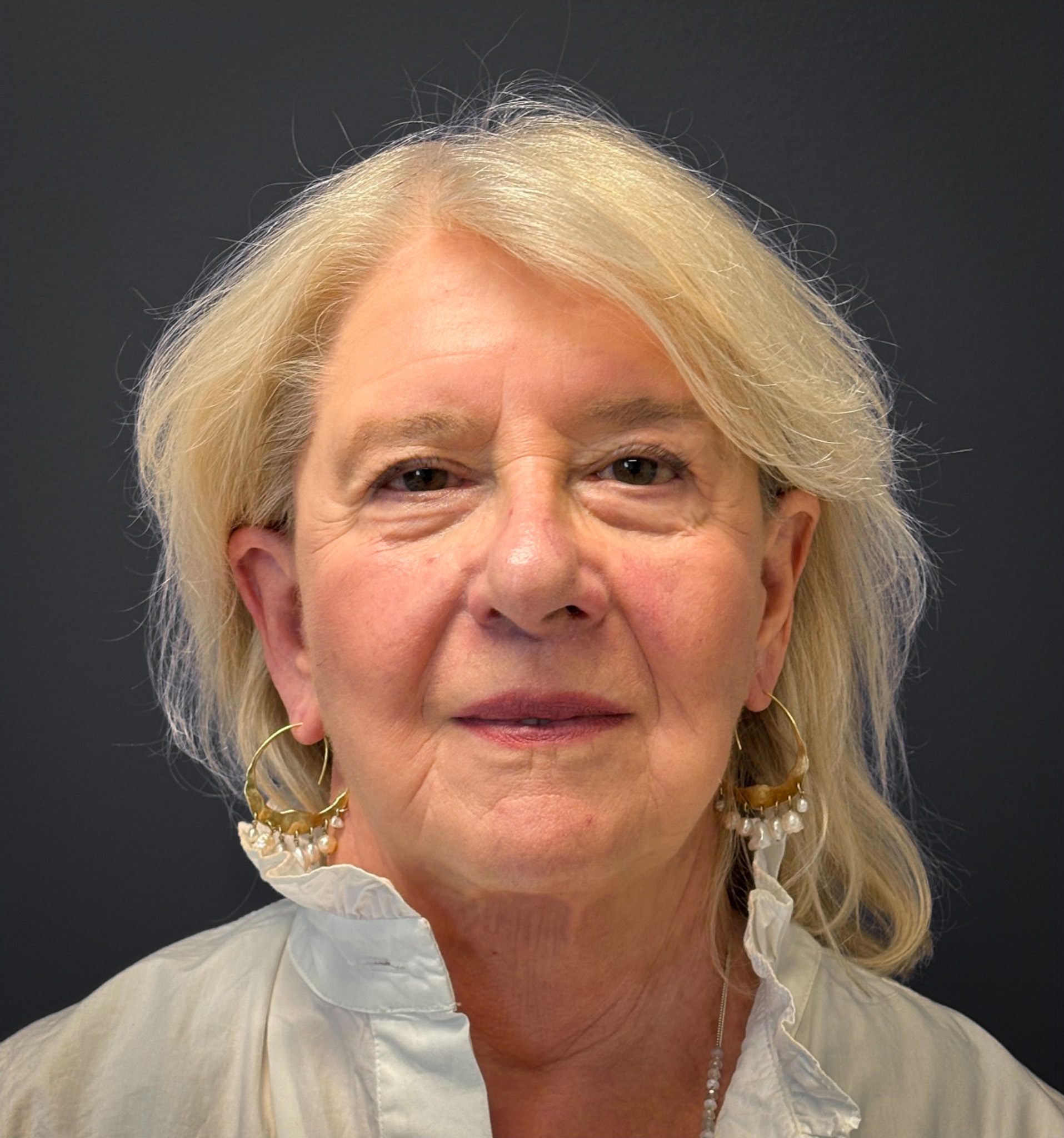 Blepharoplasty-Case--3336 | After Eyelid Surgery 2