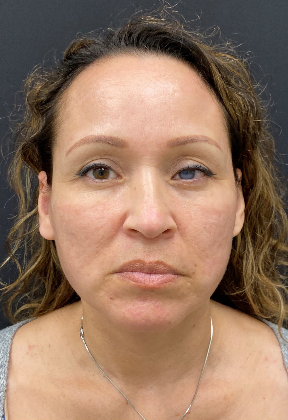 Facelift-Case--364 | After Facelift 1