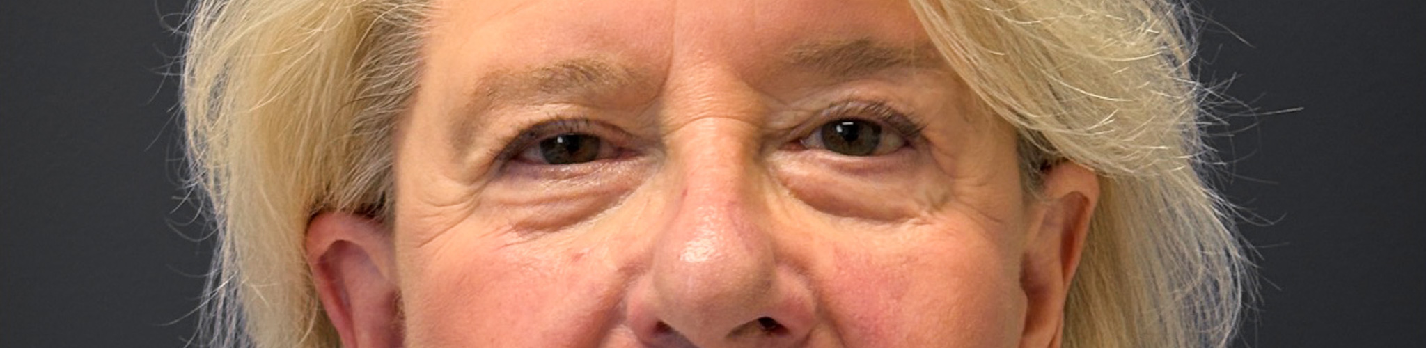 Blepharoplasty-Case--3336 | After Eyelid Surgery 1