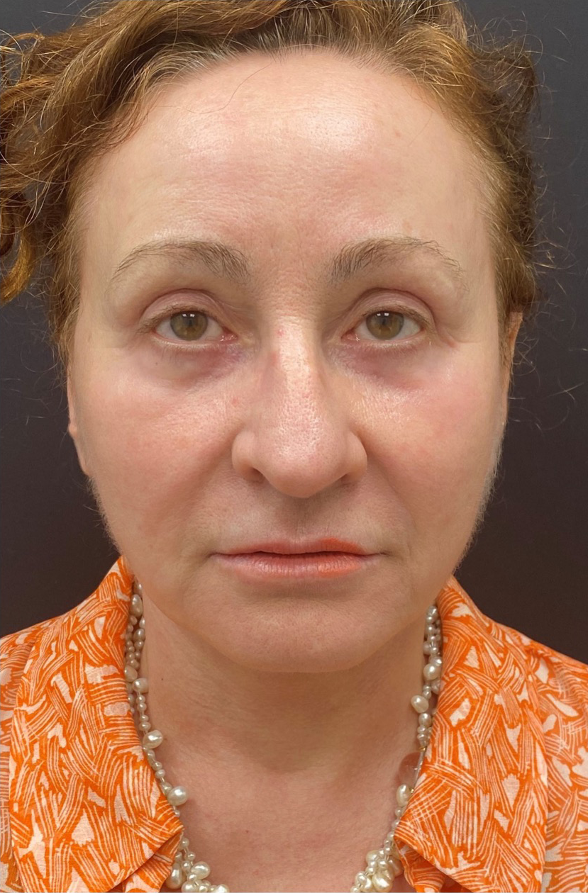 Facelift-Case--363 | After Facelift 1