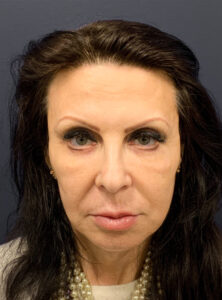 Blepharoplasty-Case--6272 | After Eyelid Surgery 2