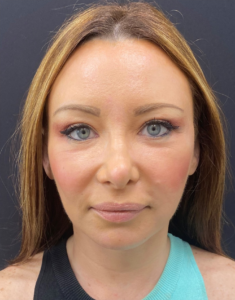 Facelift-Case--355 | After Facelift 1