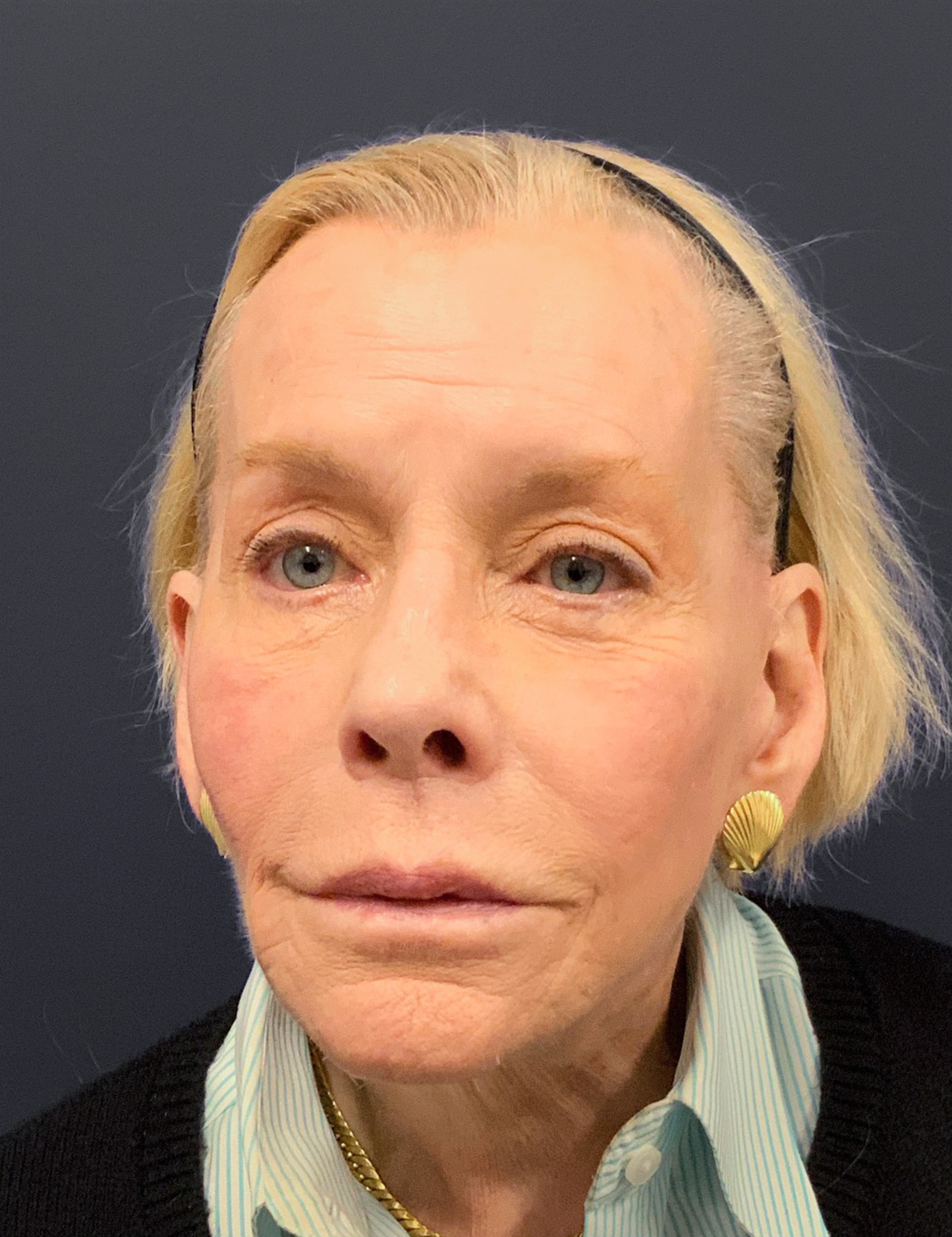 Facelift-Case--7247 | After Facelift 1