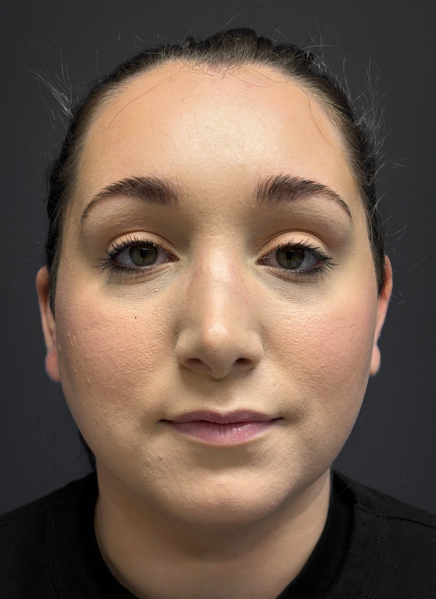 Submental-Liposuction-Case--3439 | After Liposuction 1