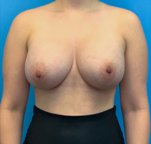 Breast-Augmentation-Case--23631 | After Dr. Arjun Kanuri 1