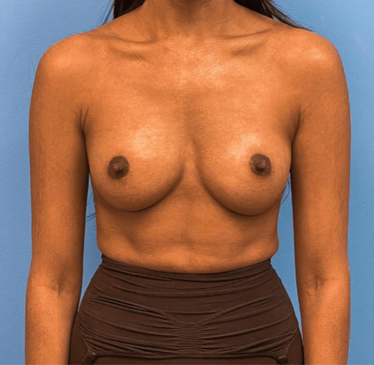 Breast-Augmentation-Case--25592 | After Breast Augmentation 1