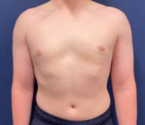 Gynecomastia-Case--214 | After Gynecomastia / Male Breast Reduction 1