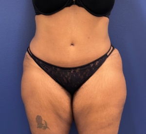 Lipoabdominoplasty-Case--245 | After Liposuction 1