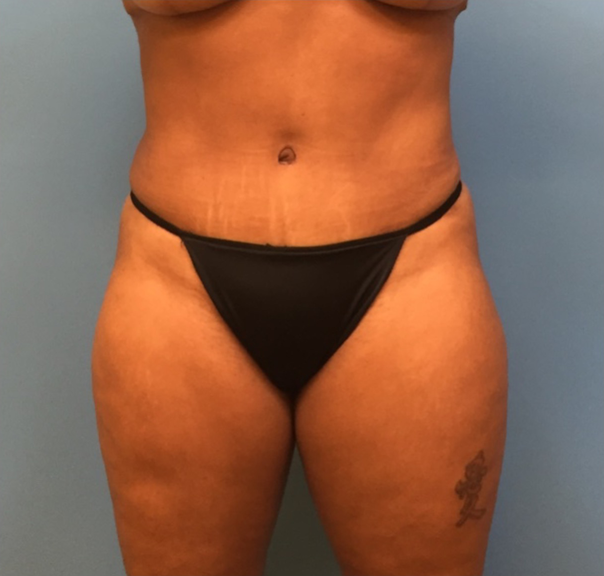 Case--247 | After Liposuction 1