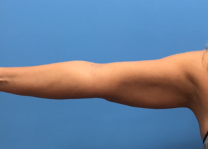 Case--280 | After Liposuction 1