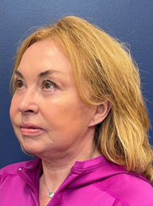 Facelift-Case--22860 | After Facelift 2