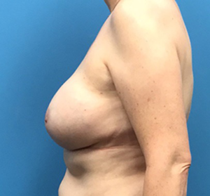 Case--135 | After Breast Reconstruction 2