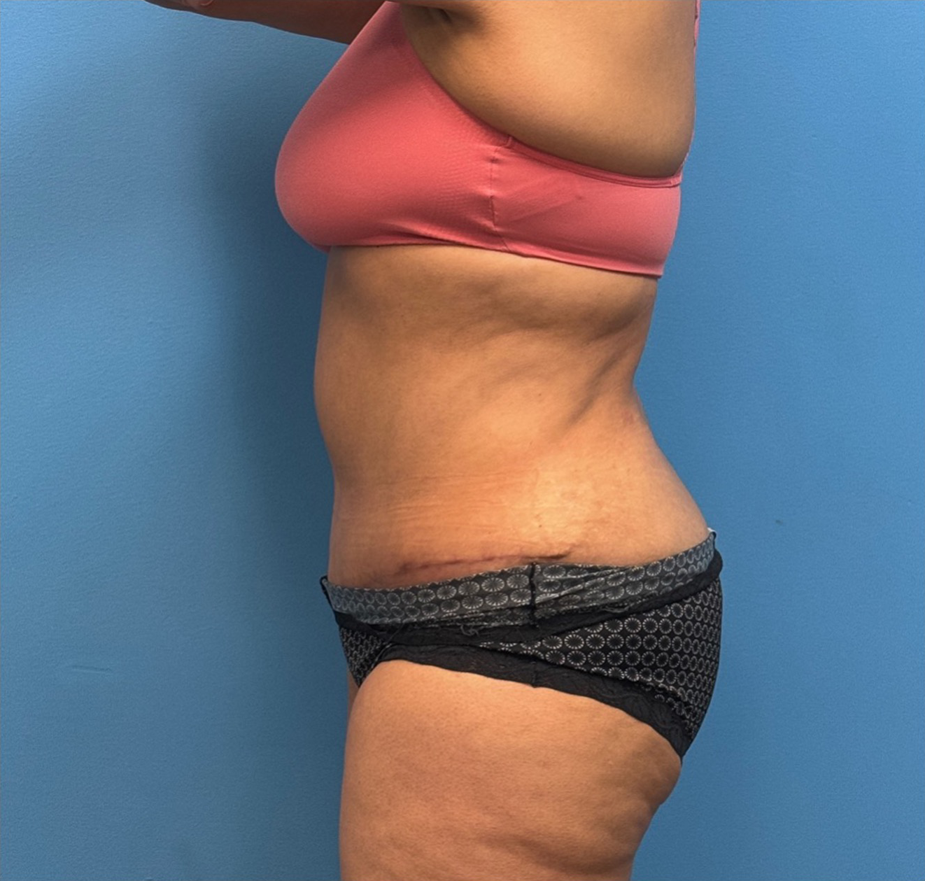 Tummy-Tuck-Case--27602 | After Liposuction 2