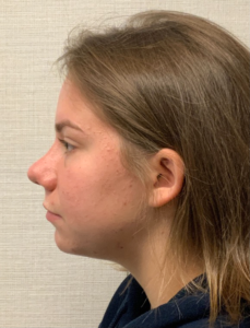 Rhinoplasty-Septoplasty-Case--23611 | After Rhinoplasty 1