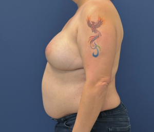 DIEP-Flap-Case--28021 | After DIEP Flap 2