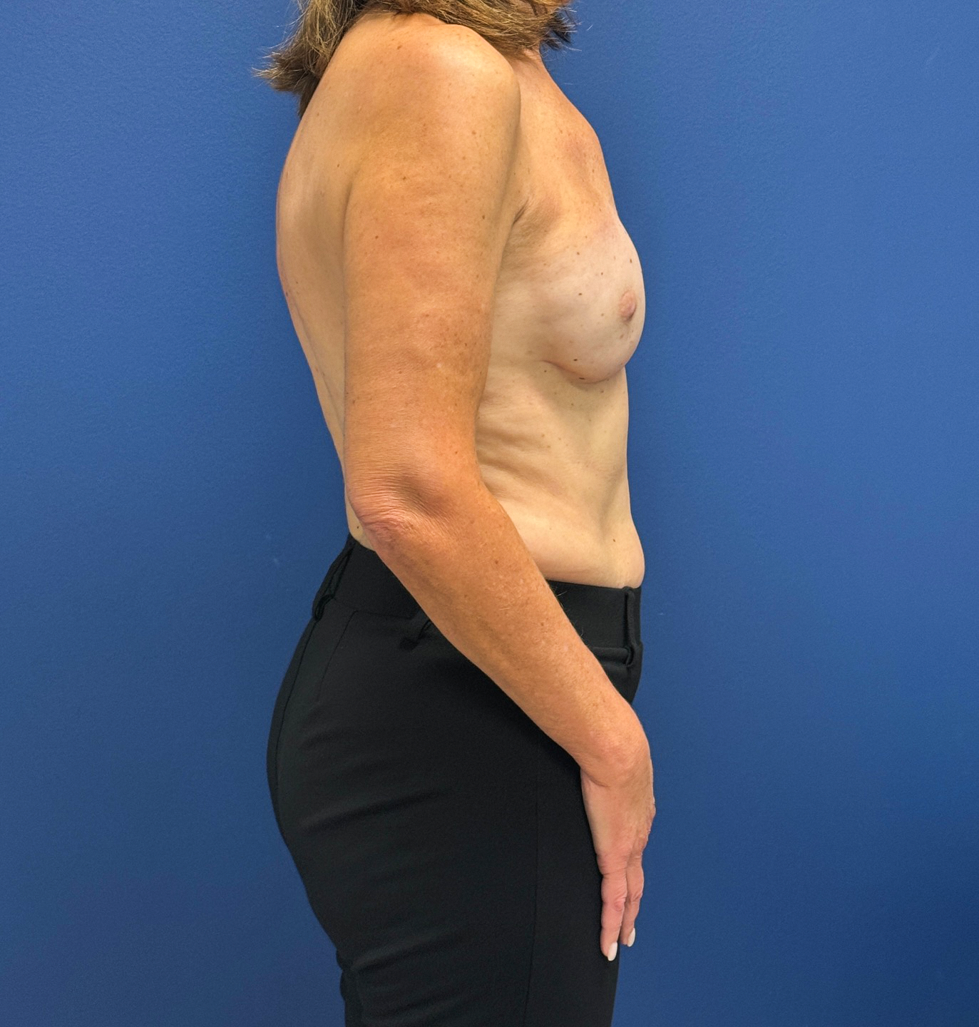 Breast-Reconstruction-Case--28688 | After Breast Reconstruction 2