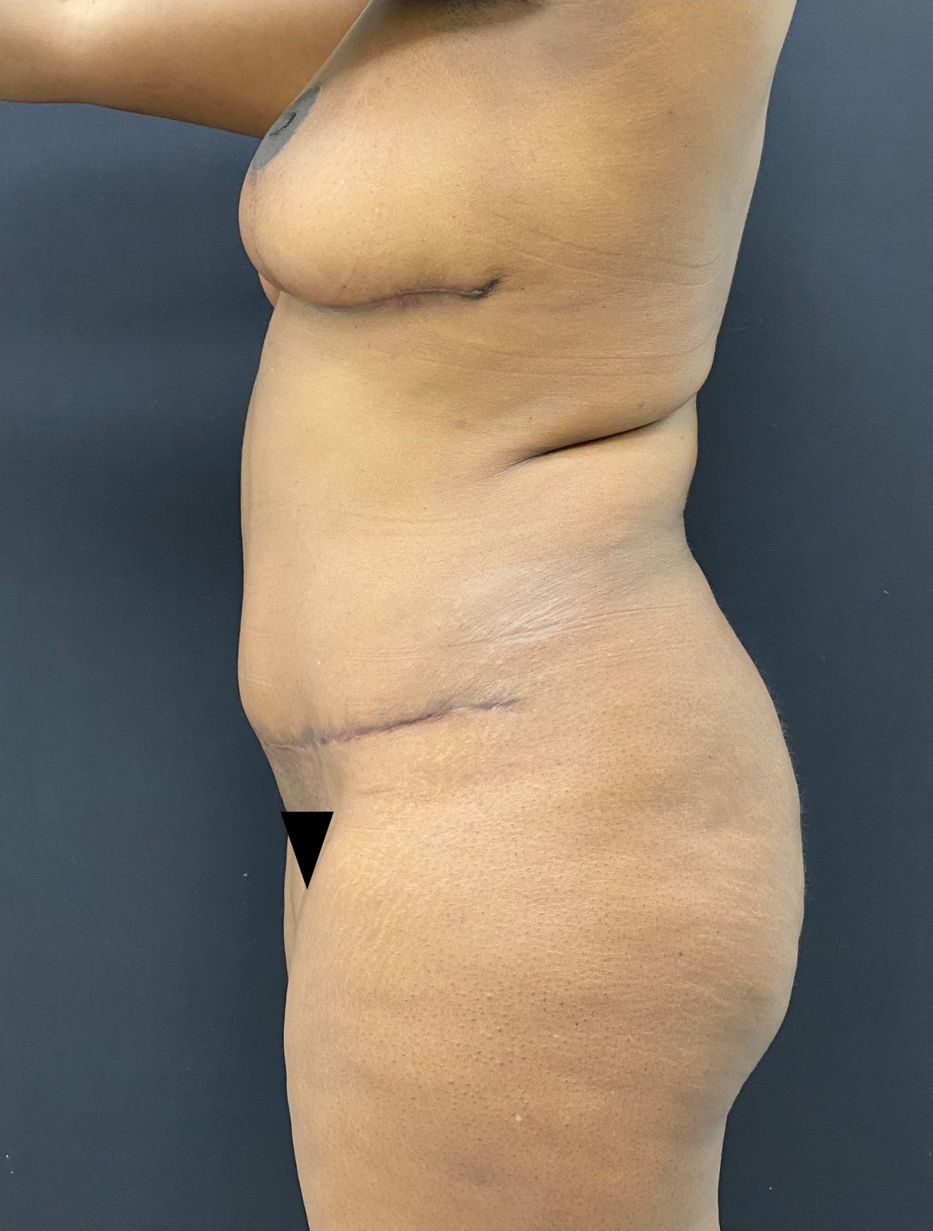 Mommy-makeover-Case--336 | After Mommy Makeover 2